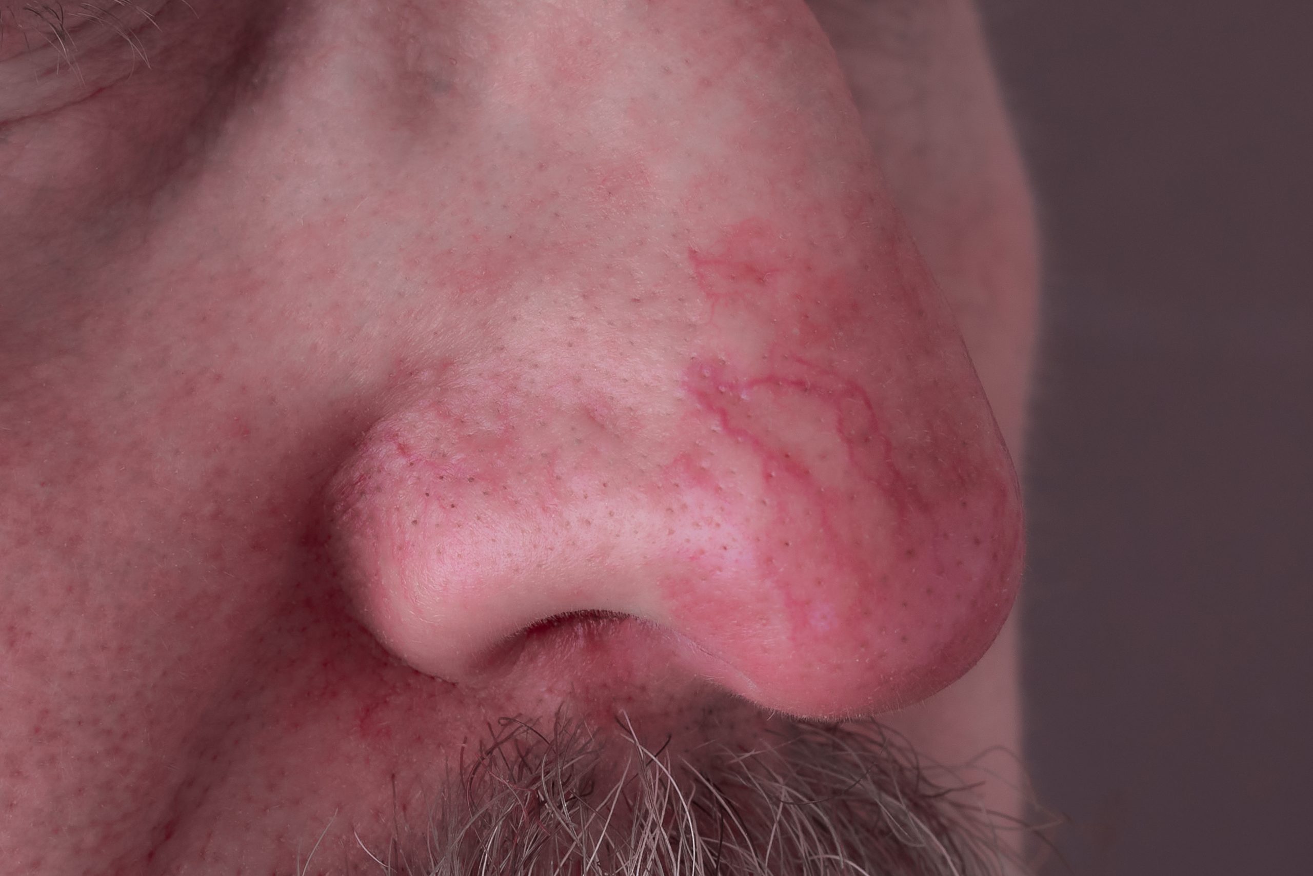 alcoholic nose skin condition